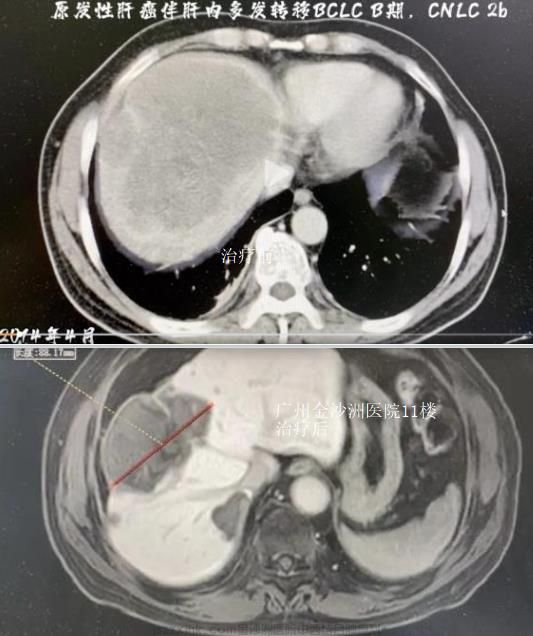 肝癌ct图成功案例前后对比照片.jpg