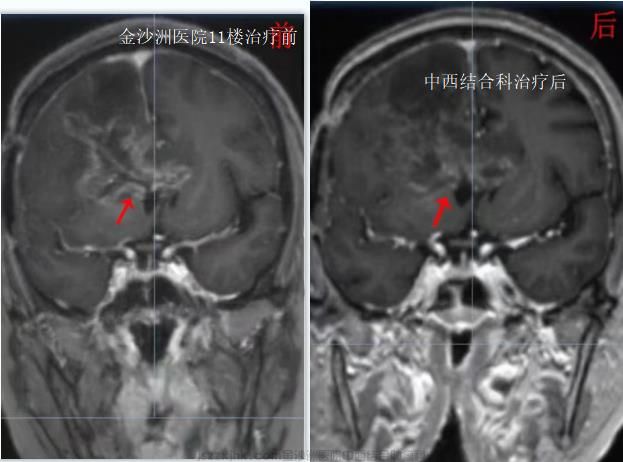 脑胶质瘤星型细胞瘤成功案例前后对比图.jpg