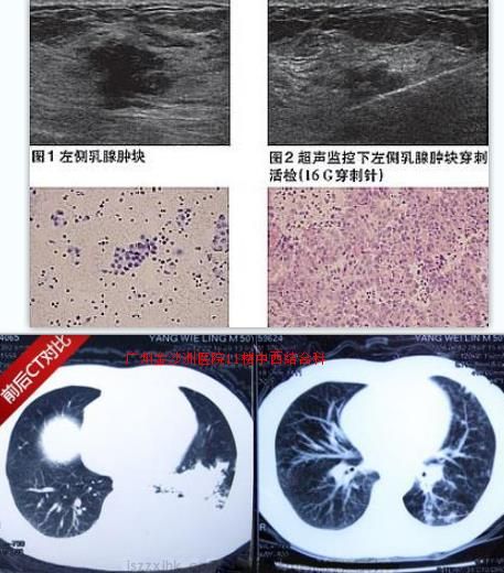 乳腺癌成功案例前后对比图.jpg