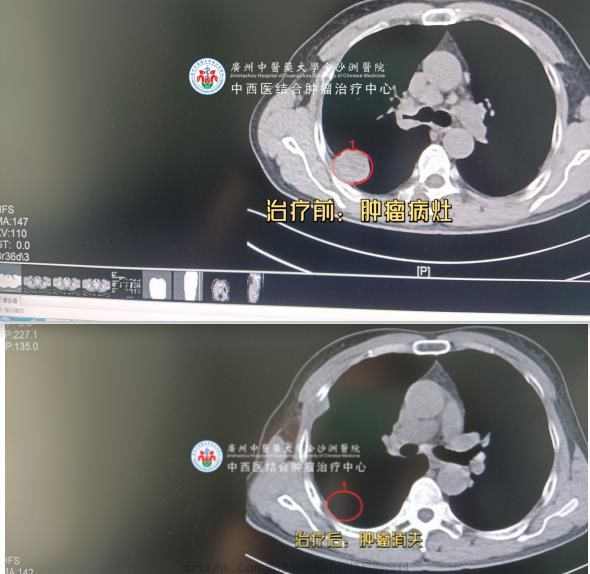 肺小细胞癌成功案例前后对比图.jpg