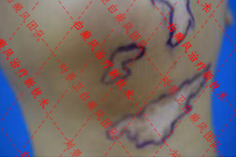 海南治疗皮肤病医院首篇在SCI发布的白癜风新疗文