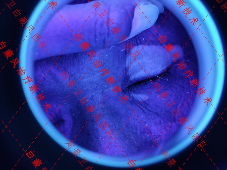 海南白癜风医院讲解白癜风属于可以自愈的皮肤病吗？
