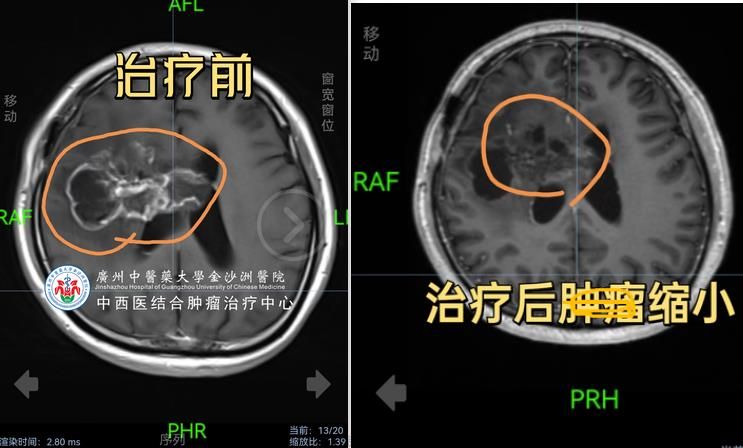 脑胶质瘤成功案例前后对比图20230808102304287.jpg