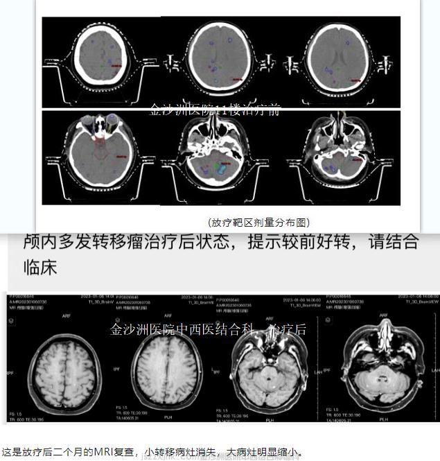 颅脑多发转移瘤成功案例前后ct图.jpg