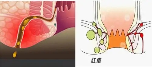 北京哪家医院治疗肛瘘好？肛瘘是怎么形成的？能自愈吗？