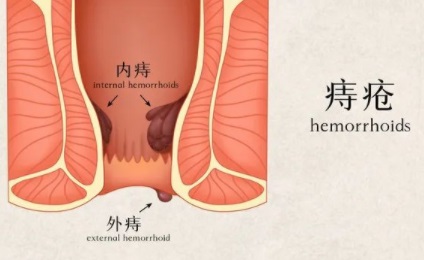 北京痔疮医院 内痔的症状有哪些？