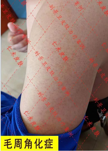 海南皮肤病医院夏季特推“鸡皮肤”消失大法！