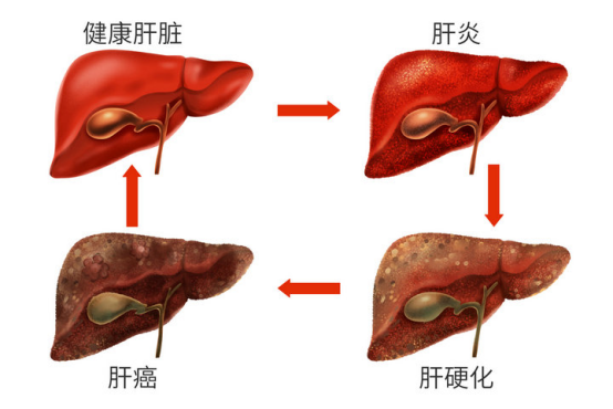 肝癌来临悄无声息，一经发现就是晚期，这样治疗可以少走弯路