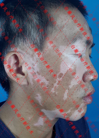白癜风患者通过海口皮肤病医院的这项白癜风新重拾自信