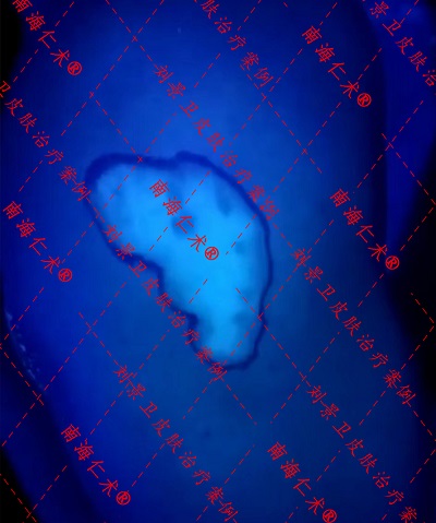 海南皮肤病学医生给308准分子激光治疗白癜风提供了个适配良方