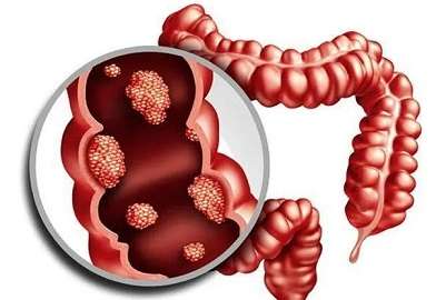 北京肠道科医院排名榜 肠息肉的症状表现有哪些？