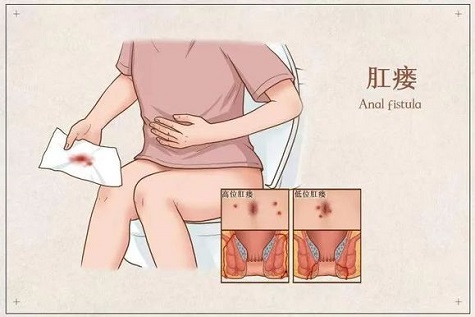 北京哪个医院的肛肠科好？肛瘘看哪个科？该怎么治？