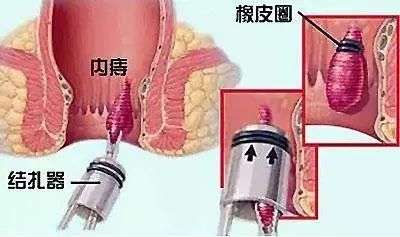 北京的痔疮医院哪家好？肛部处长了痔疮怎么回事？