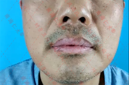 发布官宣：海南哪家医院有治疗白癜风不用磨皮的手术方法？