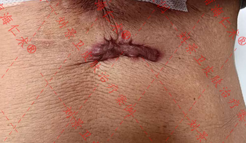 报道：海南专业皮肤医院教你如何摆脱“疤痕”烦恼！