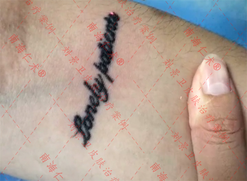 实时公开：海口皮秒激光洗纹身医院排名榜单分享！