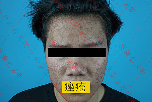 海口治疗痤疮医院哪家靠谱？过了青春期长痘得注意了！