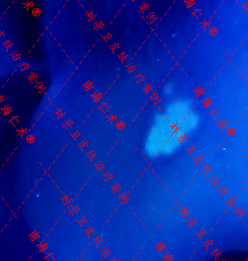 海南白癜风专科医院排名公开-患者该如何选择合适的治疗方式？