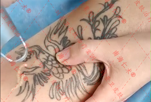 海口仁术皮肤洗纹身.png