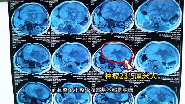 直播预告 | 利水软肝消腹水、扶正消瘤抗肝癌，来看中医如何辨证化解？