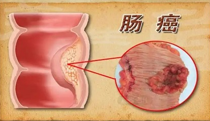 北京市肠癌早筛 大肠息肉易变癌，5个典型症状应早发现！