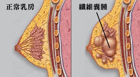 乳腺囊肿怎么引起的图片