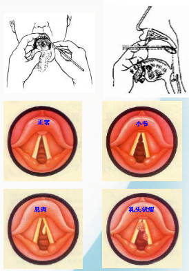 电子喉镜解剖示意图图片
