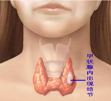 甲状腺峡部位置图图片