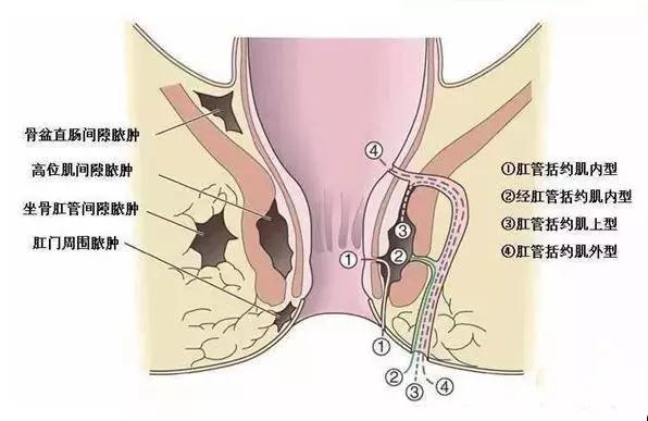 肛周囊肿早期图片初期图片