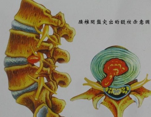 诱发腰间盘突出的3种因素是什么