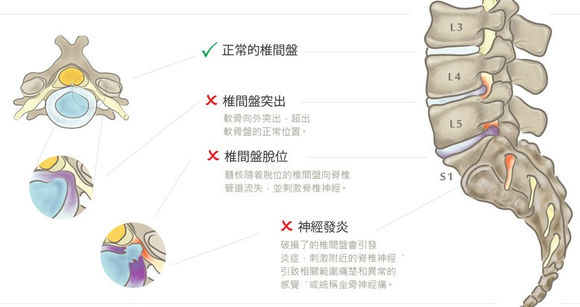 腰椎間盤突出症患者最多見的症狀為疼痛,可表現為腰背痛,坐骨神經痛.