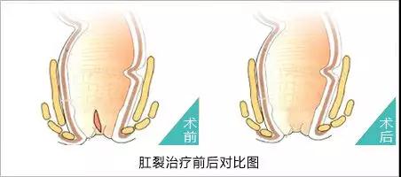 肛裂伤口愈合过程图片图片