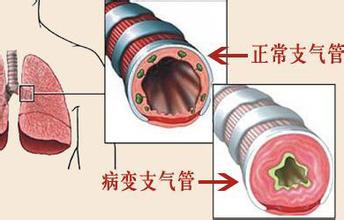 老人,儿童更易咳嗽,急性支气管炎不同时期的症状有哪些?