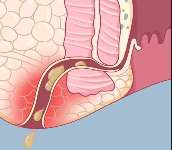 肛門旁邊腫痛,流膿,是痔瘡還是肛瘻?