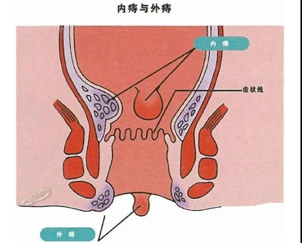 内痔外痔的区分图片图片