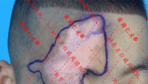 好消息 海南皮肤科医院推出适合儿童白癜风治疗的手术新方法