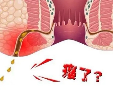 北京肛肠医院治疗肛瘘好吗？肛瘘是怎么来的？严重吗？好治吗？