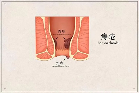北京治痔疮哪家医院好？内痔便桖，不疼不痒，需要管它吗？