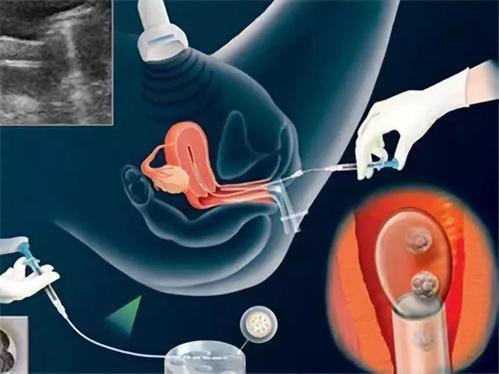 莆田做三代试管婴儿有什么误区?看了这些要避开