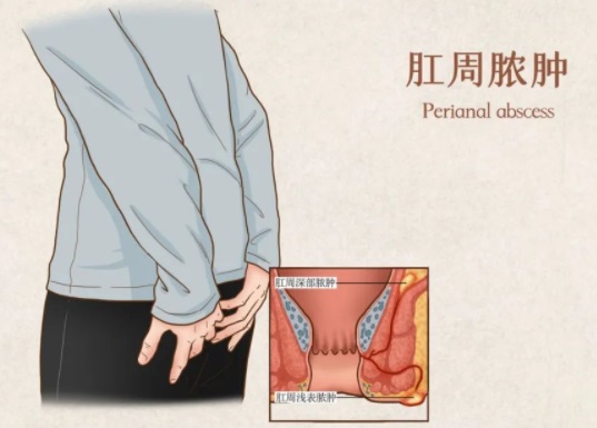 北京肛周脓肿引流术做得好的医院？肛周脓肿有什么早期征兆？