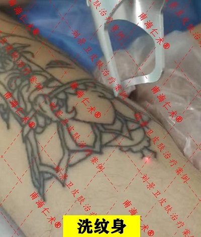 正在线磋商 海南海口正轨皮肤病院疾捷消释纹身的要领有哪些？