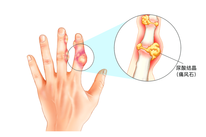 手痛风的症状图片大全图片