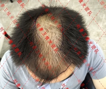 海南专业毛发病院 头发一天不洗就油腻且大方脱发是什么源由？