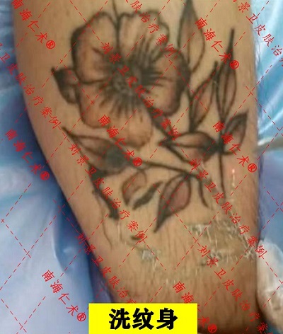 海南皮肤专科医院 未成年人可以使用激光清洗纹身吗？