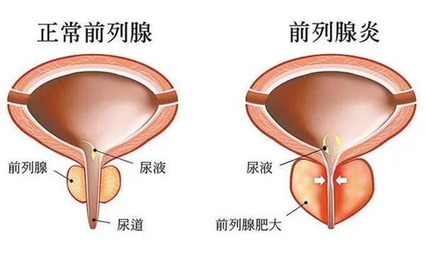 前列腺炎——男人的痛，如何让男人摆脱“腺”制、活力再“腺”？