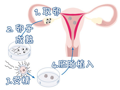 重庆输卵管壅塞也许做试管婴儿帮孕吗?试管婴儿流程圭臬
