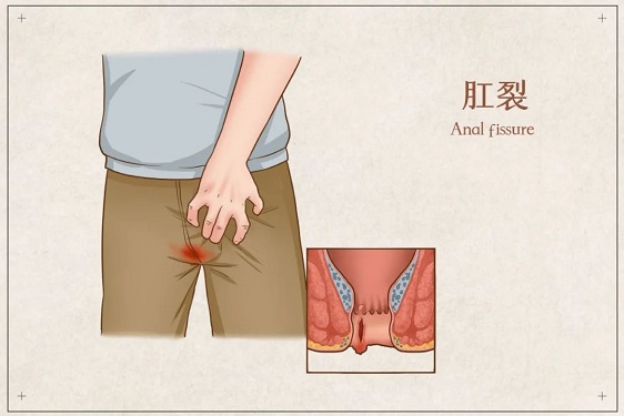  北京做肛裂手术哪家医院好？肛裂患者日常生活中需要注意哪些？