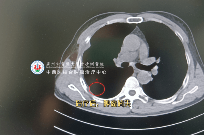 肺小细胞癌患者重获新生，“M6射波刀准确治疗”帮大忙！ 