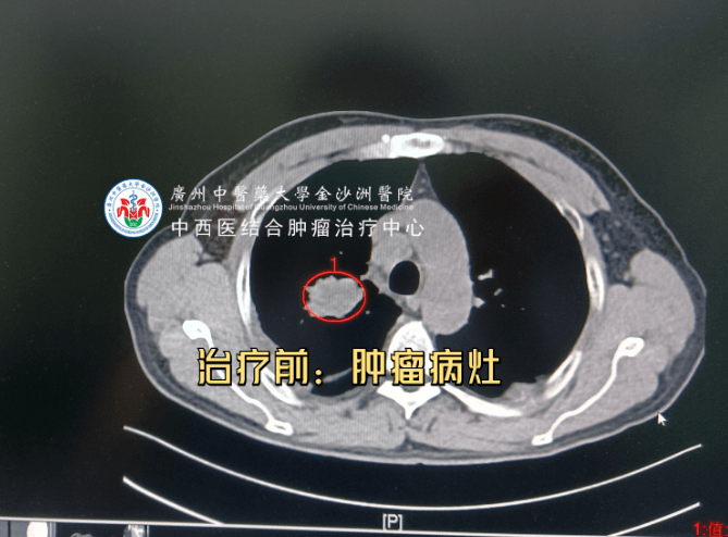 肺小细胞癌患者重获新生，“M6射波刀准确治疗”帮大忙！ 