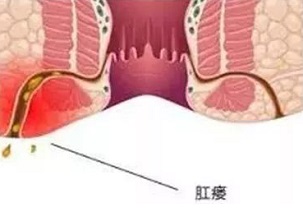 北京肛肠医院治疗肛瘘好吗？如何早期发现肛瘘？